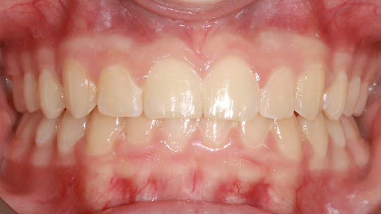 After treatment — bite aligned