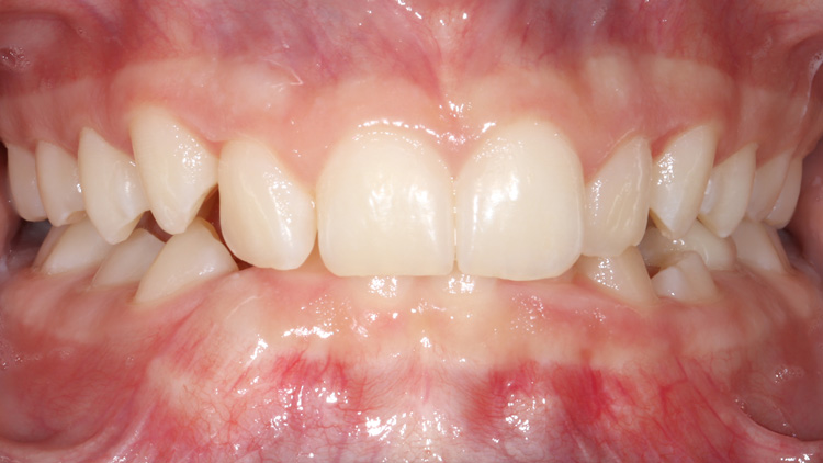 Before treatment — bite