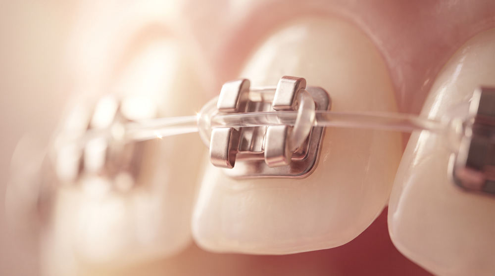 Macro close-up of an orthodontic bracket