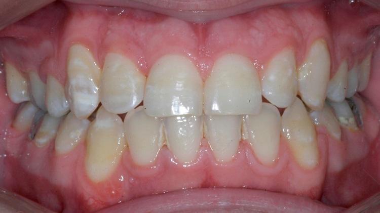 After treatment — crowding corrected