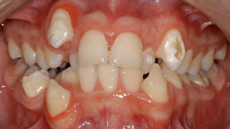 Before treatment — crowding