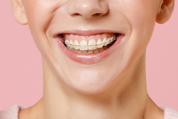 Detail of braces on aligned teeth