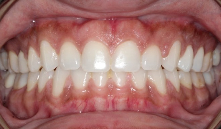 After treatment — gap closed