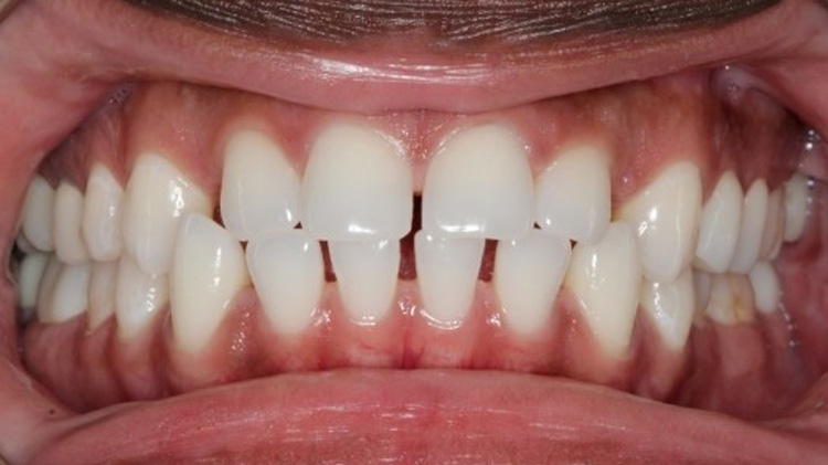 Before treatment — spacing